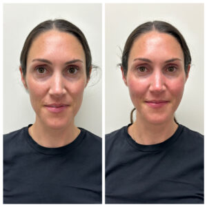 Before and After Sculptra Full Face