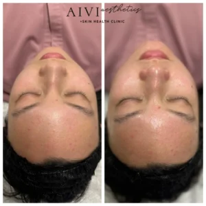 image result of a hydrafacial done in aivi aesthetics