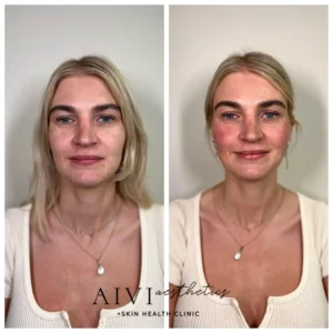 before-after-thread-lift-1