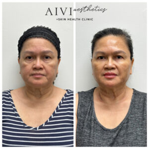 PDO Thread Lift Agoura Hills