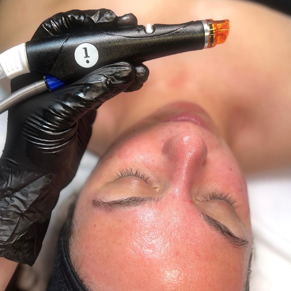 hydra-facial-agoura-hills