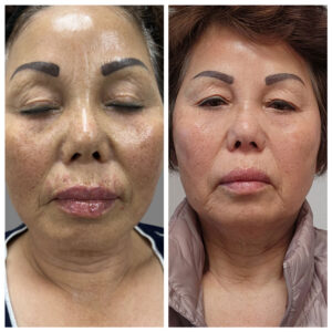 Vi Peel Before After 2