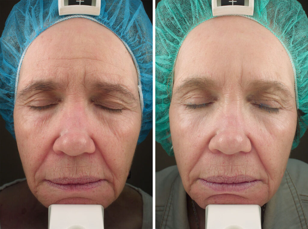 Vivace Microneedling Before After 3 Agoura Hills