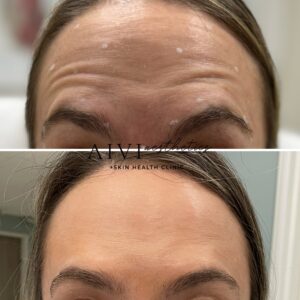 before-after-botox-dysport-daxxify-5