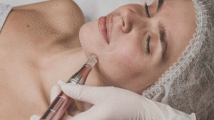 woman undergoing microneedling with PRP treatment