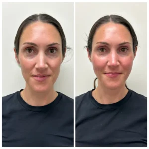 before and after sculptra