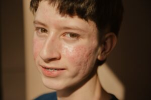 acne scars
