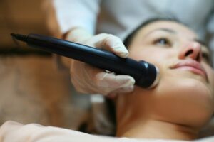 RF microneedling