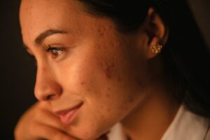 repair acne scars with vampire facials
