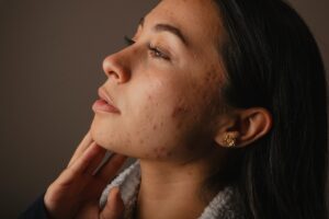 acne scar treatment