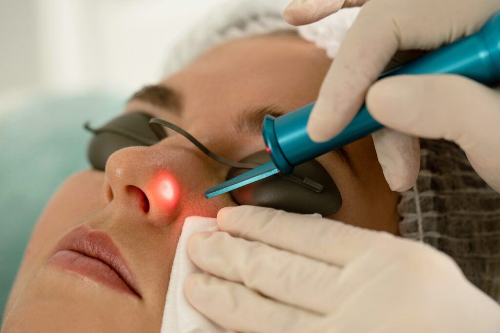 Acne Scar Laser Treatment