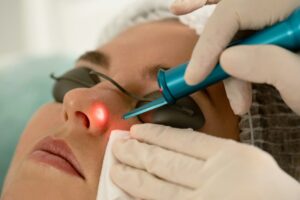 Acne Scar Laser Treatment