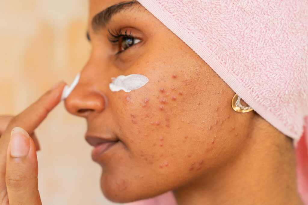 Chemical Peels for Acne Scars