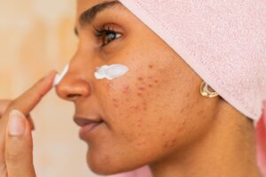 Chemical Peels for Acne Scars