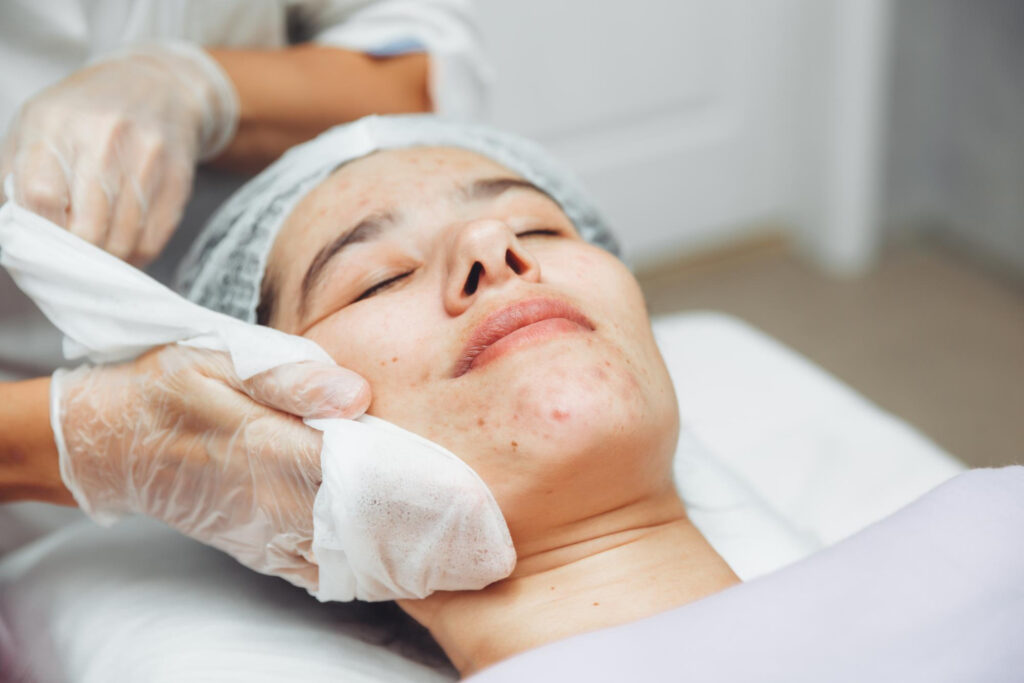 Acne Scar Treatment