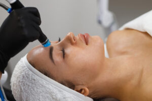 RF Microneedling