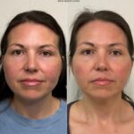 Before After Aivi Aesthetics Coolpeel Co2 Laser