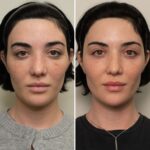 Before And After 2 Co2 Laser Aivi Aesthetics