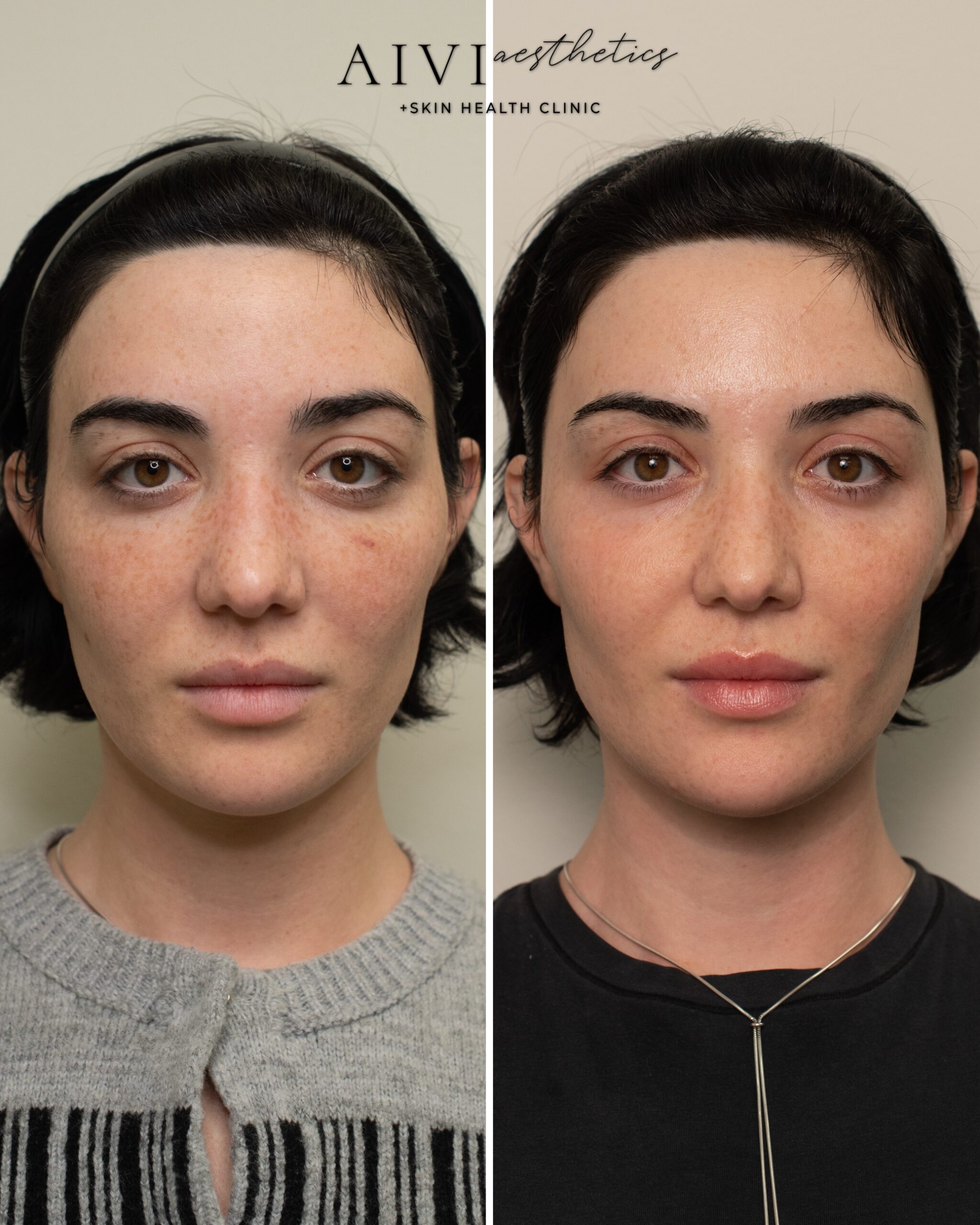 Before And After 2 Co2 Laser Aivi Aesthetics med spa agoura hills