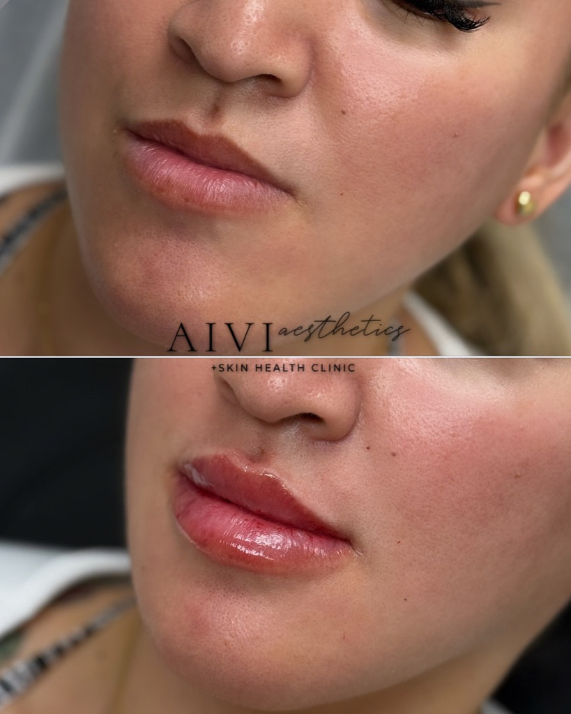 Lip Filler AIVI Aesthetics Agoura Hills Med Spa 3