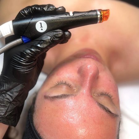 hydra-facial-agoura-hills