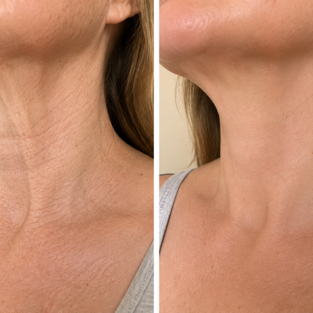 neck skin tightening radiesse aivi aesthetics med spa agoura hills